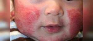 علائم مسمومیت کودکان با مواد شوینده (1)