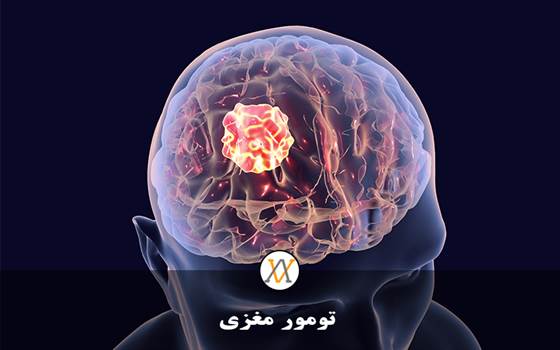 تومور مغزی